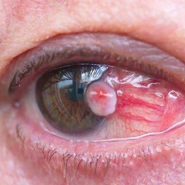 Pterygium: The Silent Epidemic and The Uncelebrated Eye Killer of the Century—Urgent Call to Action from ACSPD.