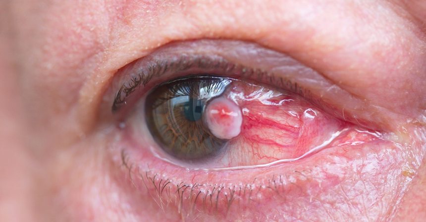 Pterygium: The Silent Epidemic and The Uncelebrated Eye Killer of the Century—Urgent Call to Action from ACSPD.