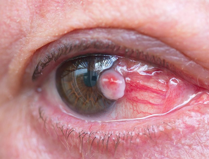 Pterygium: The Silent Epidemic and The Uncelebrated Eye Killer of the Century—Urgent Call to Action from ACSPD.